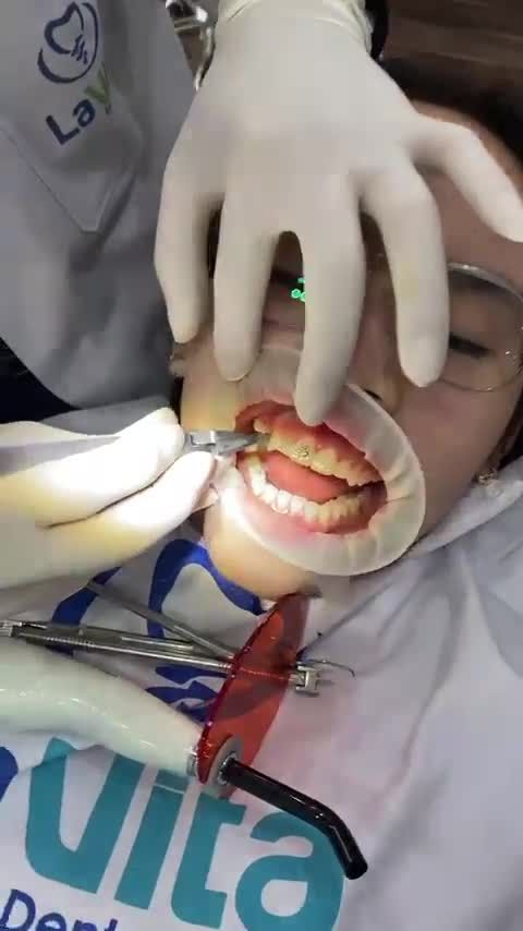 Thời điểm tốt nhất để chỉnh nha cố định là trong vòng 2 năm sau khi bắt đầu dậy thì vì đây là lứa tuổi cơ thể còn đang phát triển, xương hàm còn chưa cố định